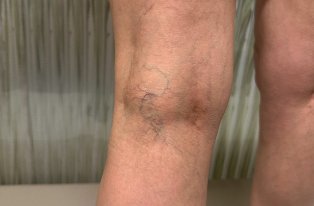 Köpük Skleroterapi